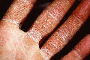 Air pollution is making eczema worse in adults