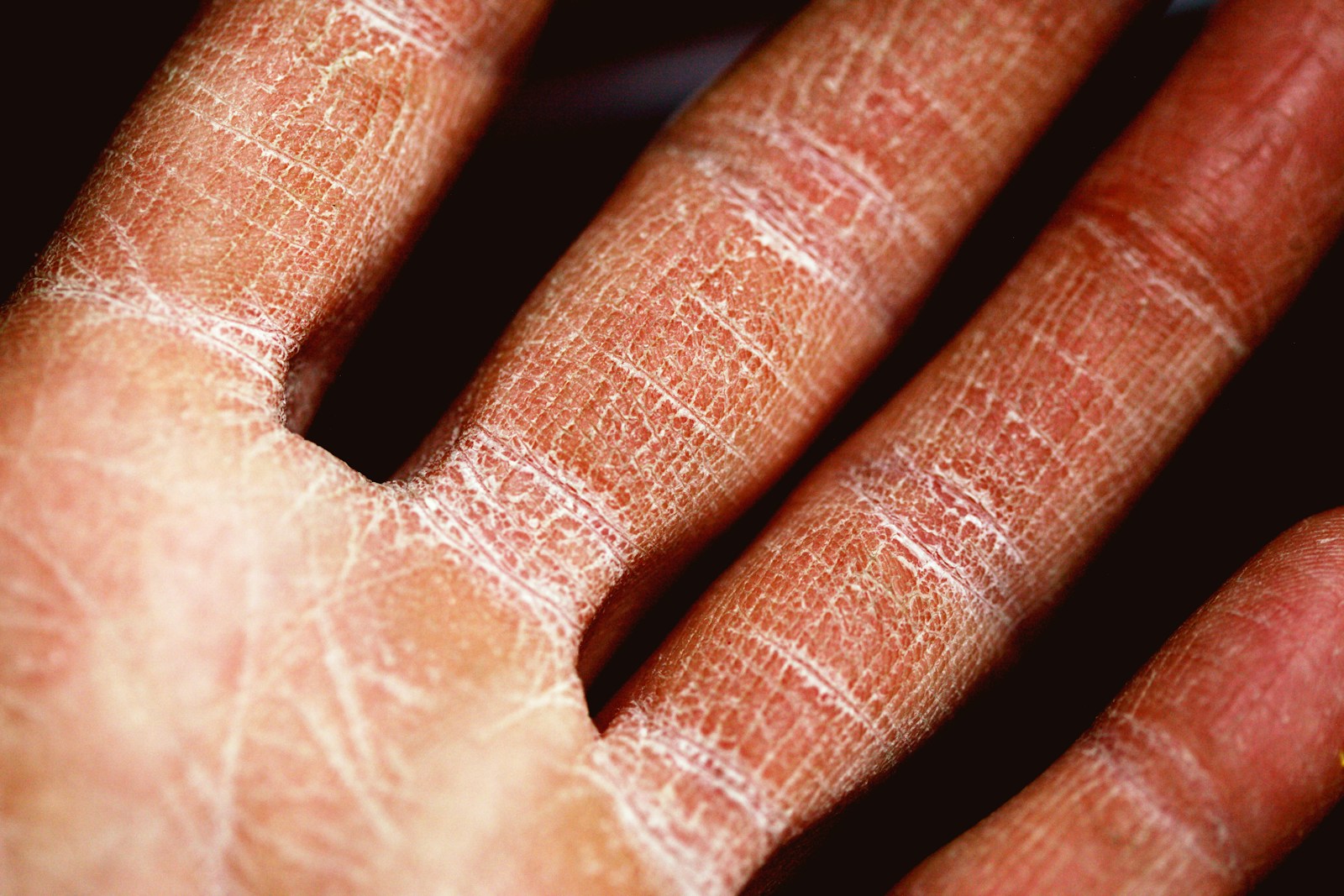 Air pollution is making eczema worse in adults