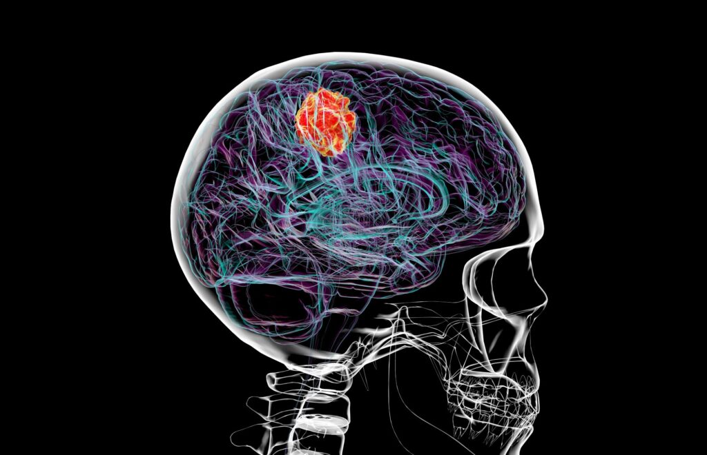 Air pollution may be linked to brain tumours