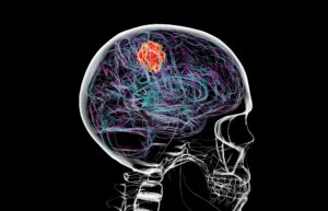 Air pollution may be linked to brain tumours